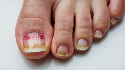 Say Goodbye to Nail Fungus