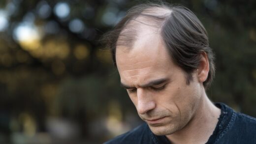 Hair Loss Myths: The Truth About a Receding Hairline